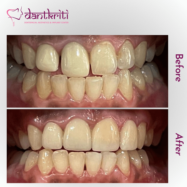 Before and after pic of smile after replacing old teeth caps with new aesthetic caps and veneers