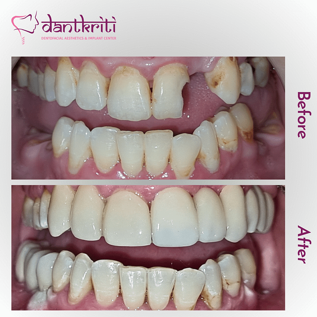 Before and After Images of Cosmetic dental treatment with Dental Implant Root canal treatment dental veneer and dental crowns